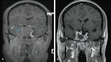 testing the seal on dura reconstruction after pituitary adenoma removal|transseptal pituitary tumor treatment.